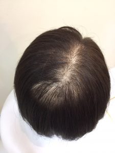 抗がん剤治療後の髪をカットカラー、トップピースでフルウィッグ卒業！