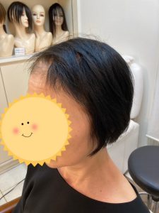 抗がん剤治療後の薄い部分をトップピースで完全カバー！