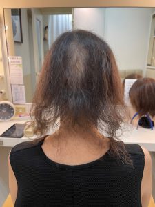 脱毛で全体的に薄い状態をカットカラートップピースで大変身