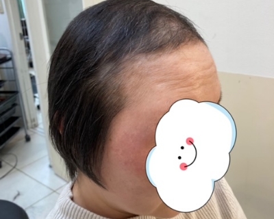 自毛が短くてもOK